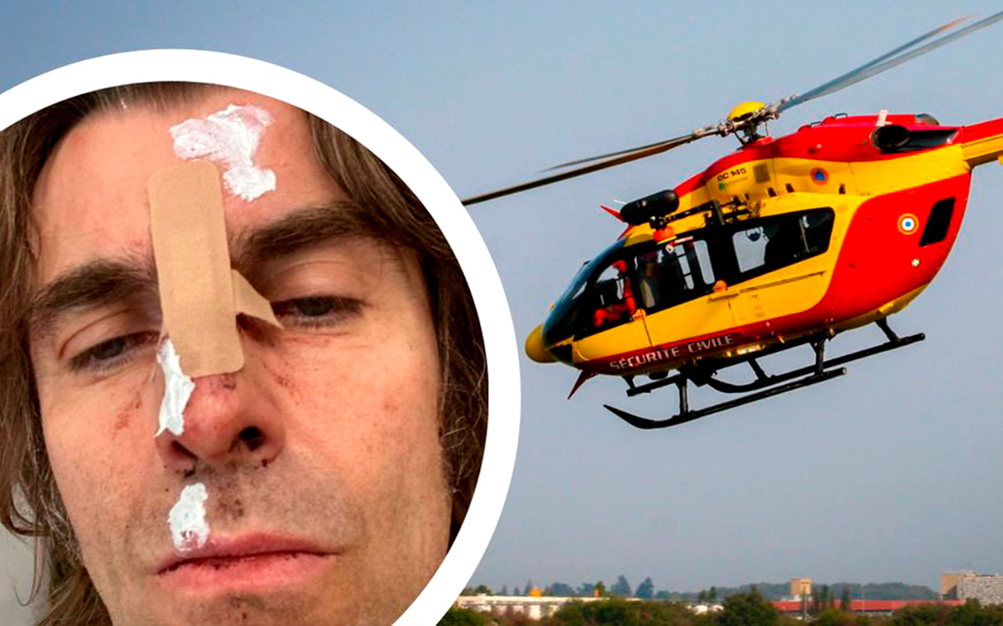 Liam Gallagher muestra sus heridas tras caer de un helicóptero